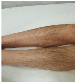 A before image of a man with hair leg that is about to undergoe laser hair removal