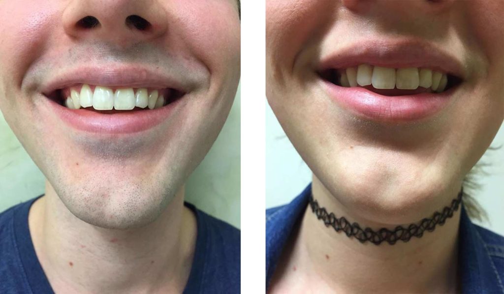 patient’s chin before and after laser hair removal, stubble not visible after treatment