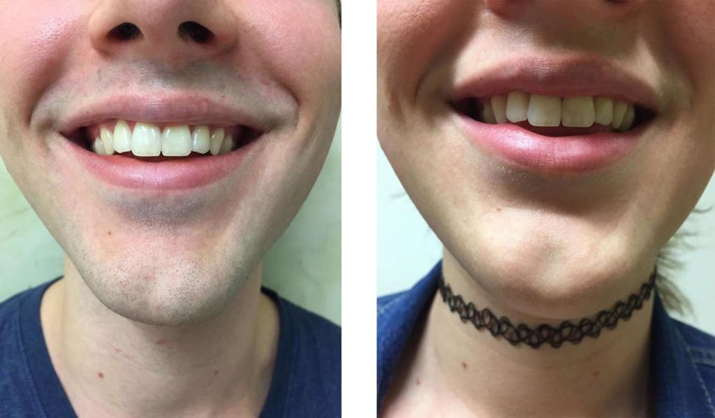 BeforeAfter 1024x598 1