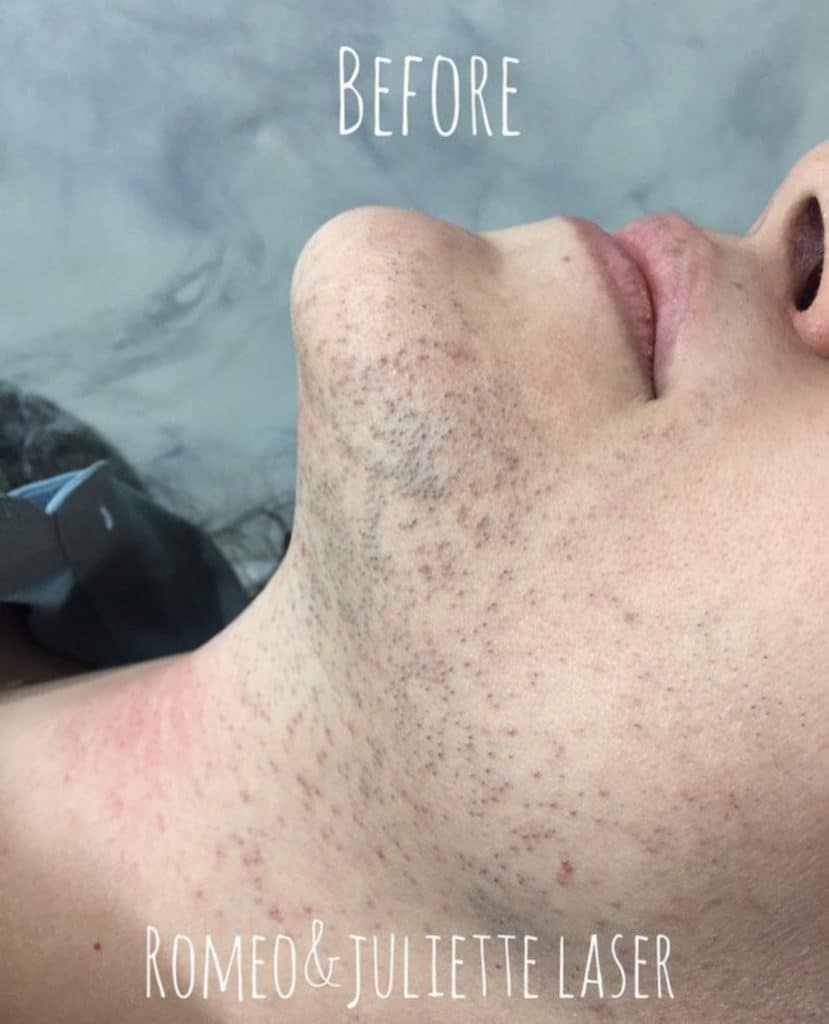 Facial Laser Hair Removal In NYC〡Midtown Manhattan Facial Laser Hair Removal In NYC〡Midtown Manhattan