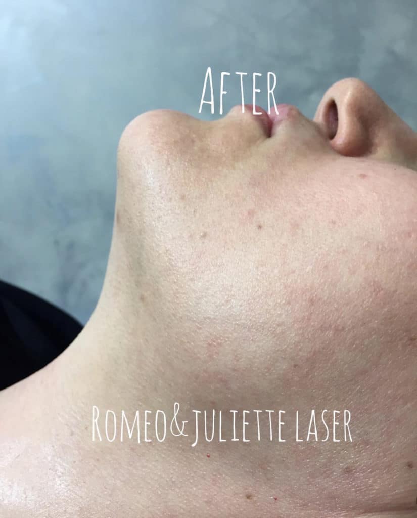 PCOS Laser Hair Removal in NYC | Facial Laser Hair Removal in NYC PCOS Laser Hair Removal in NYC | Facial Laser Hair Removal in NYC