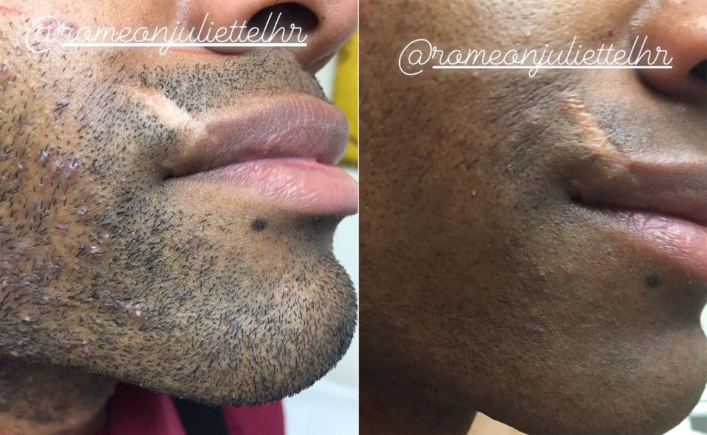 male patient’s cheek and chin before and after laser ingrown hair removal, ingrown hairs gone and skin smoother after procedure