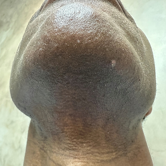 After Image: African American Laser Hair Removal - front
