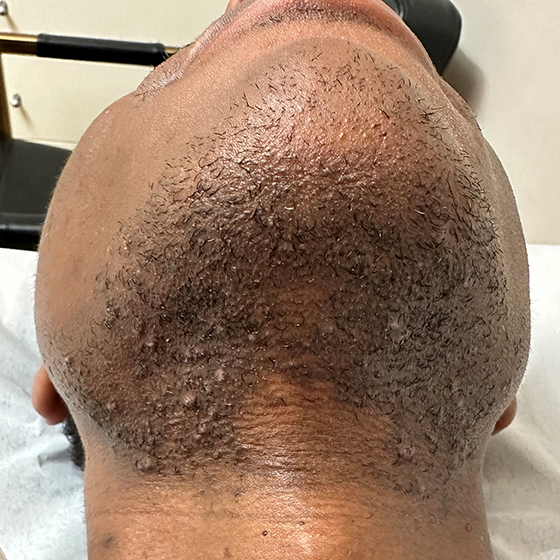 Before Image: African American Laser Hair Removal - front