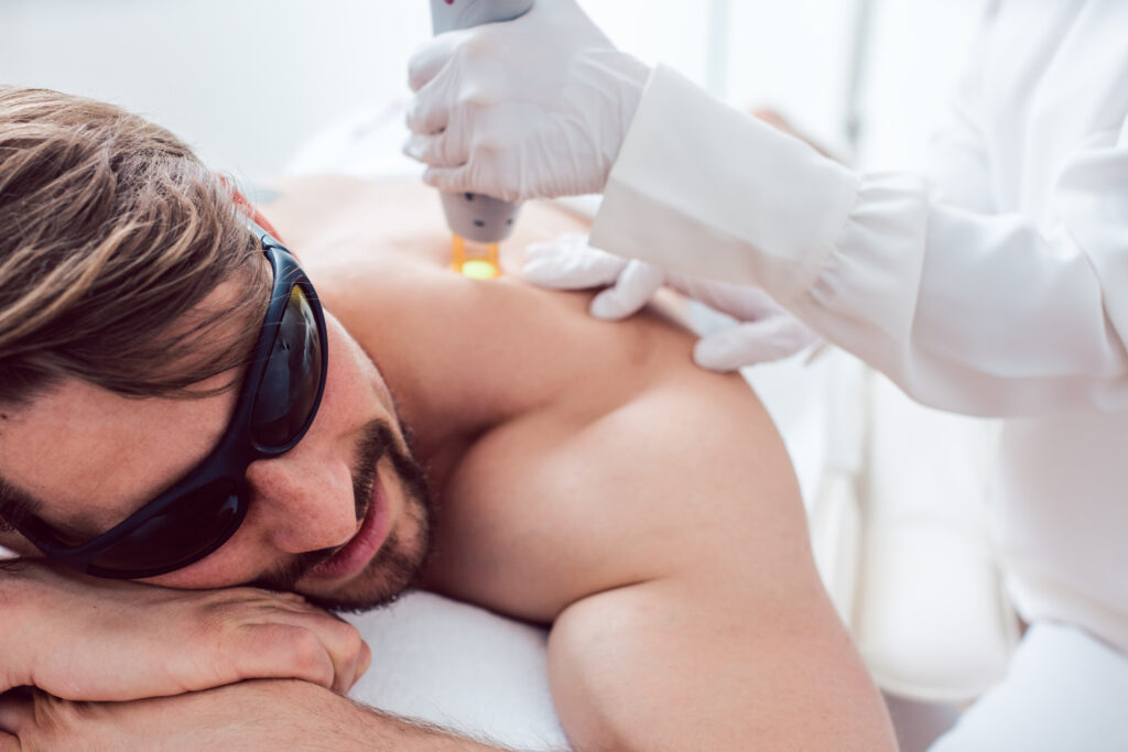 laser hair removal on back