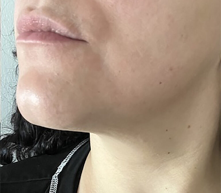 After Image: PCOS Laser Hair Removal - left-front-oblique