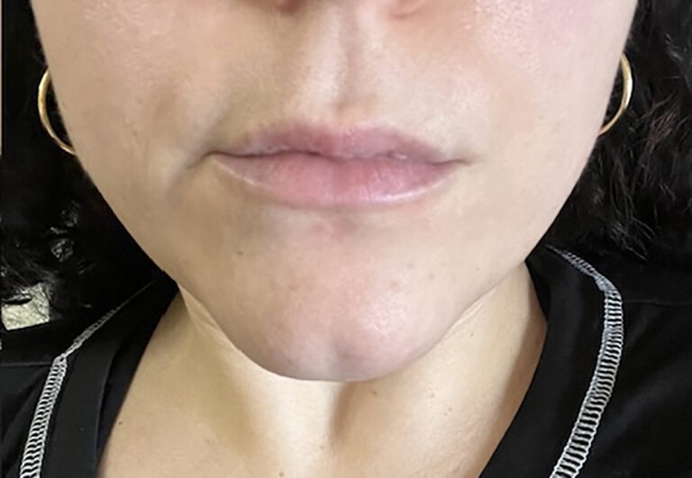After Image: PCOS Laser Hair Removal - front