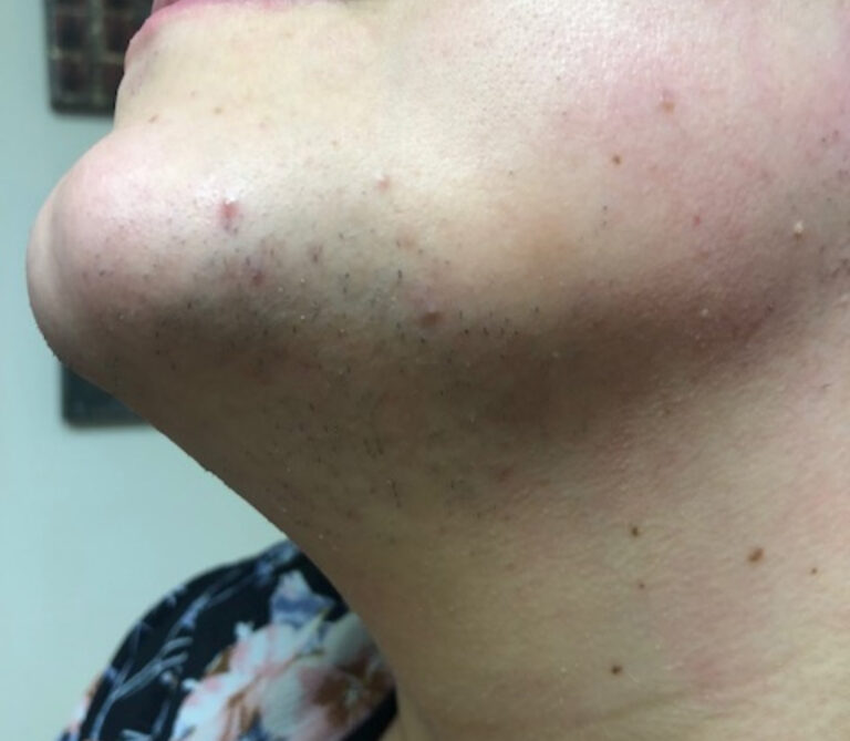 Before Image: PCOS Laser Hair Removal - left-front-oblique