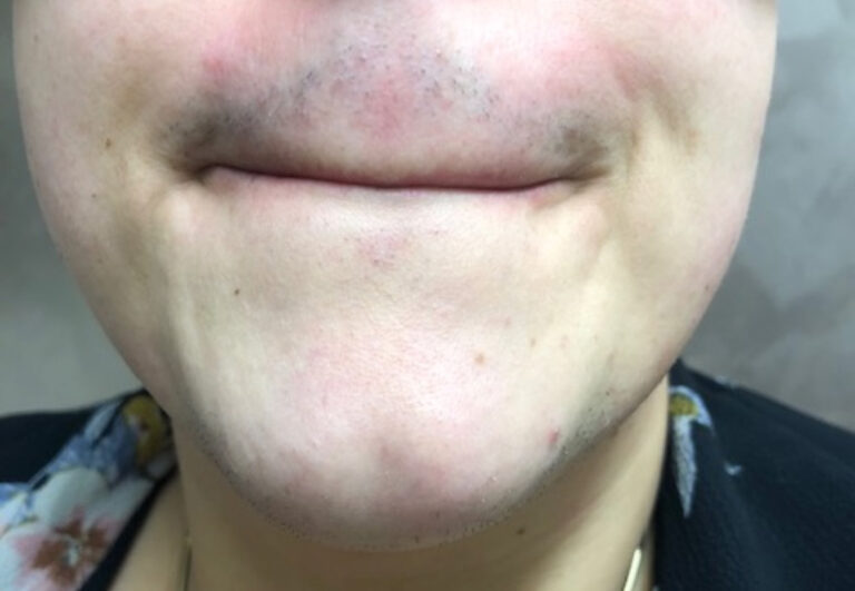 Before Image: PCOS Laser Hair Removal - front