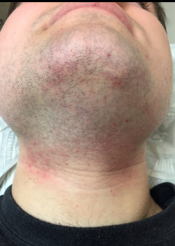 Male Facial Hair Removal Case ID: 1221