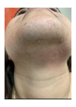 Facial Laser Hair Removal Case ID: 1596