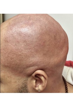 After Image: Male Head Hair Removal Case ID: 0606 - left-side
