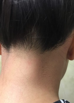 Back Of Neck Hair Removal Patient #0649 | Before and After Gallery