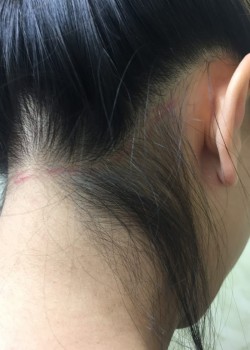 Before Image: Back of Neck Hair Removal Case ID: 0649