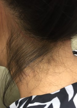 Back Of Neck Hair Removal Patient #0649 | Before and After Gallery
